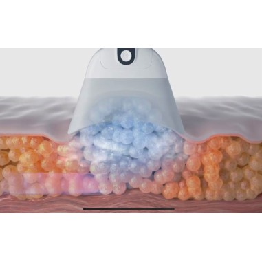 Cryolipolyse LIPOFREEZE® 360° - Destruction des...