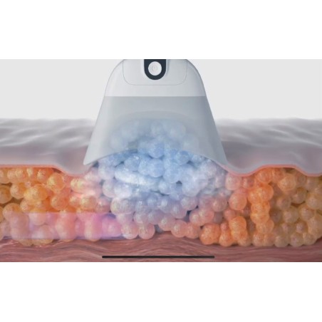 Cryolipolyse LIPOFREEZE® 360° - Destruction des graisses