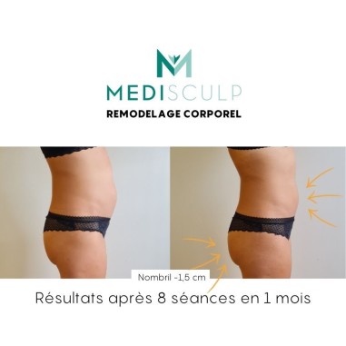 EMS MEDISCULP 10 Tesla - Remodelage corporel