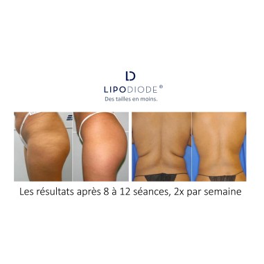 Lipolaser LIPODIODE - Dissolution des graisses