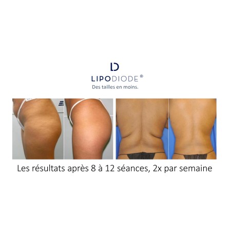 Lipolaser LIPODIODE - Dissolution des graisses