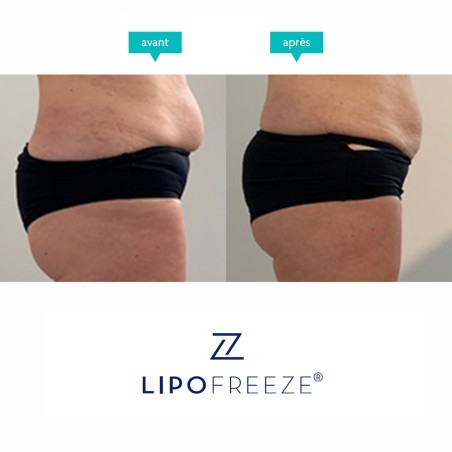 LIPOFREEZE® 2S - Cryolipolyse