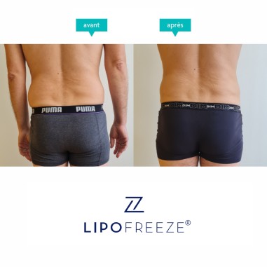 LIPOFREEZE® 2S - Cryolipolyse