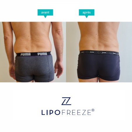 LIPOFREEZE® 2S - Cryolipolyse