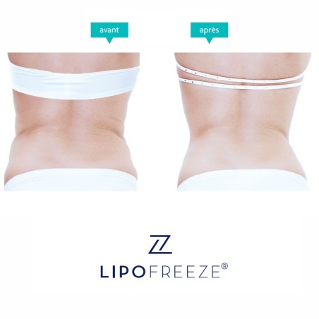 Cryolipolyse LIPOFREEZE® 360° - Destruction des graisses