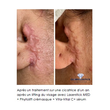 LASERSTICK PRO 🍃Microdermabrasion