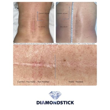 LASERSTICK PRO 🍃Microdermabrasion