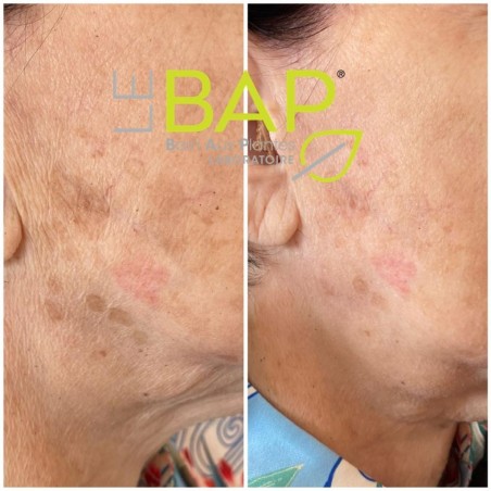 LASERSTICK PRO 🍃Microdermabrasion