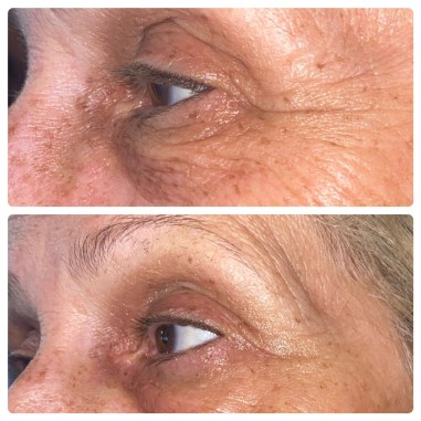 LASERSTICK PRO 🍃Microdermabrasion