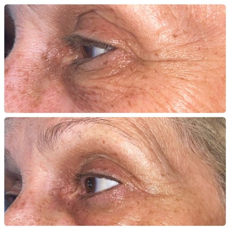 LASERSTICK PRO 🍃Microdermabrasion