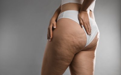 Peut-on vraiment traiter la cellulite avec la cryolipolyse ?
